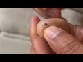 blood blister 🤣 how i got rid of it asmr