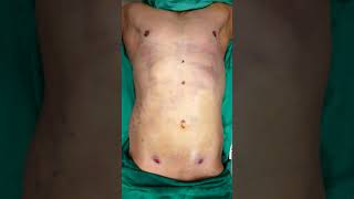 360 Abdominal Liposuction | Liposuction cost | Liposuction surgery #dezireclinicindia