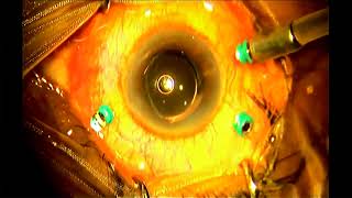 AIOC2018 - GP112 - Topic - [VT11] : THE OCULAR ANGIOPLASTY : VITRECTOMY ...