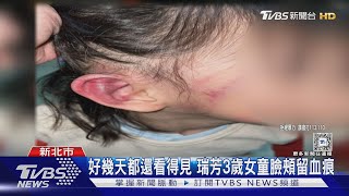 瑞芳3歲女童遭毆！小腿留棍棒狀瘀青.耳朵紅腫 幼園：口罩拉扯所致｜TVBS新聞 @TVBSNEWS02