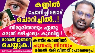 കണ്ണിൽ ചൊറിച്ചിലോട് ചൊറിച്ചിൽ തിരുമിയാലും മരുന്നൊഴിച്ചാലും വിണ്ടും വരുന്നു ; ഇത് മാറാൻ ഒരു എളുപ്പവഴി