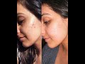 MY CYSTIC ACNE JOURNEY // Hormonal Acne | Next With Nita