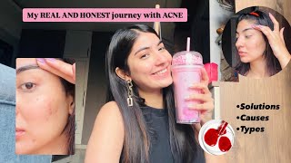 My HONEST journey with Acne! Causes, Types and Solutions! 🧉🧉