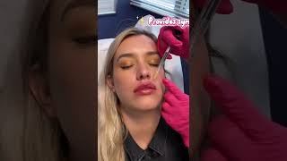 Lip Fillers