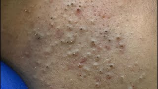 Deep Cleansing Techniques — Amazing Acne Removal Facial Care Routine