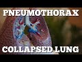 Pneumothorax Collapsed Lung: Quick & EZ [Episode 3]