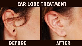 Ear Lobe Treatment, easy method, no pain, no stitches
