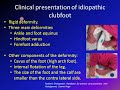 clubfoot talipes equinovarus tev