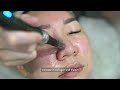 microneedling skin tightening u0026 collagen production bio aesthetic