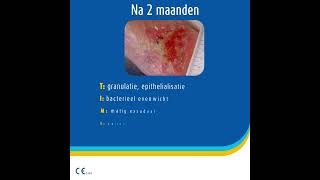 Case Studie - Flaminal® voor de behandeling van veneuze ulcera