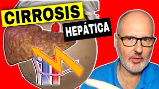 CIRROSIS HEPÁTICA 💥 Causas, Síntomas y Tratamiento