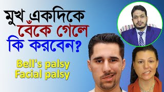 Facial Palsy || মুখ একদিকে বেঁকে গেলে করনীয় কি || Bell’s Palsy