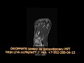 morton s neuroma of trabecular otek of the 1st metatarsal bone on rashiff mri of the foot