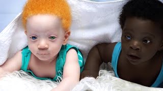 Remember The Black Twins With Different Colors? This Is what Happened To Them!
