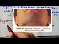 elephantiasis dengue ringworm human health and disease neet