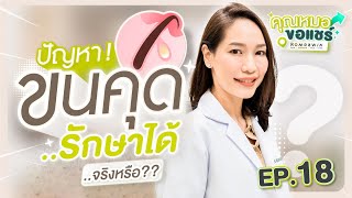 คุณหมอขอแชร์ | EP.18 ปัญหาขนคุด รักษาได้จริงหรือ