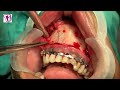 Fracture Treatment - Broken Jaw