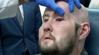 U.S. man 1st to have whole eye transplanted from organ donor