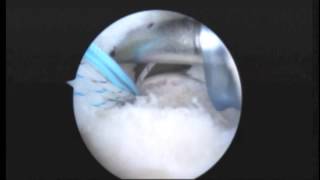 MS R shoulder arthroscopic rotator cuff repair 3 16 15