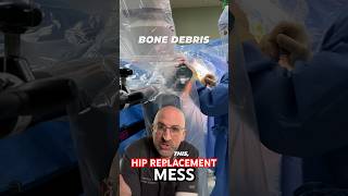 Bone Shaving Mess in Hip Replacement Surgery #shorts