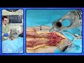 robotic assisted upper thoracic pedicle screws andrew manista m.d.