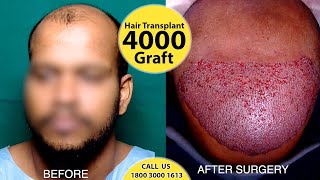 4000 Grafts Hair Transplanted in Single day | முடி மாற்று அறுவை சிகிச்சை in Chennai