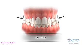 Correcting Posterior Crossbites