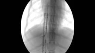 Transjugular coil embolization of an intrahepatic portosystemic shunt