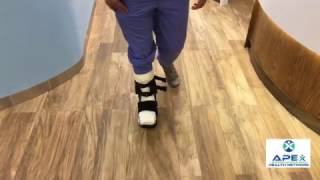 How to walk with a total contact cast (TCC)