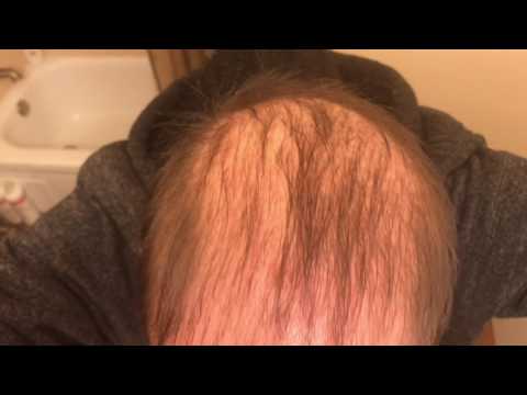 Lost Almost All Hair in 2 Years - Seborrheic Dermatitis? Lost Almost All Hair in 2 Years - Seborrheic Dermatitis?