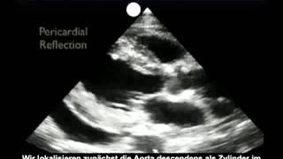 Anleitung: Kardiologische Ultraschalluntersuchung – parasternal, lange Achse – Teil 2