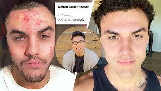 The Healthy Skin Coach Reacts To The Dolan Twins Acne