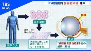 世界初、失明のおそれある患者にｉＰＳ細胞使い網膜移植手術