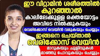 വെരിക്കോസ് വെയിൻ മാറാൻ ഇങ്ങനെ ചെയ്താൽ മതി