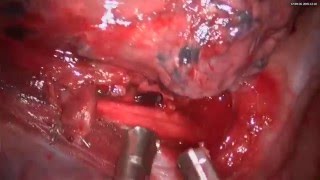 Non intubated uniportal VATS anatomic right apical segmentectomy (S1)