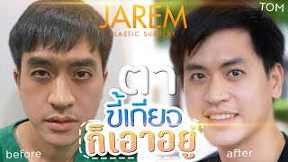 กล้ามเนื้อตาอ่อนแรงแต่กำเนิด รักษาแล้ว หล่อเลย |Jaremclinic