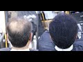 How to apply Toppik hair fiber - Men Hair transformation 2022