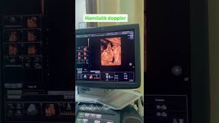 26 həftəlik baby #ultrasound #fetal #hamiləlik #3d