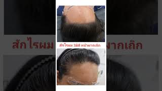 หน้าผากเถิก ไม่ต้องไปลูกผม #สักไรผม3มติ 085-7643693