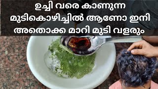 നിങ്ങളുടെ ഉച്ചി തല വരെ കാണുന്ന രീതിയിൽ മുടി കൊഴിയുന്നുണ്ടോ ❓️കെട്ടു കെട്ടായി പോകുന്ന മുടി കൊഴിച്ചിൽ