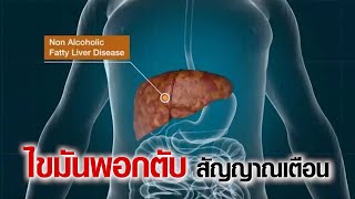 รู้จัก “ไขมันพอกตับ” สาเหตุ อาการ การรักษา สาระดีๆ จากหมอจีน BUCHANG FESTINE เอินเวย์