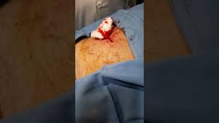 Mole surgical removal