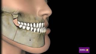 Corrective Jaw Surgery - mandibular setback 3D