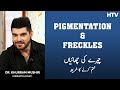 Pigmentation and Freckles Treatment by Dr. Khurram Mushir | Clinic Online | HTV