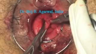 Stapled Trans Anal Rectal Resection (Starr) For Obstructed Defecation Syndrome (Ods)