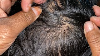 #nitspicking  wife removed husband lices super video || long hair find lice and remove💯part8💯