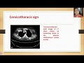 cervicothoracic sign must know classical signs in thoracic radiology thoracic radiology