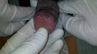 sintomas del papiloma humano en hombres tratamiento