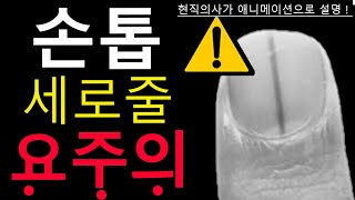 절대 놓치지 말아야 할 손톱의 SOS 사인 5가지