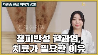 청피반성 혈관염, 괴사가 생길 확률은 얼마나 되나요? What are the chances of developing necrosis from livedoid vasculitis?